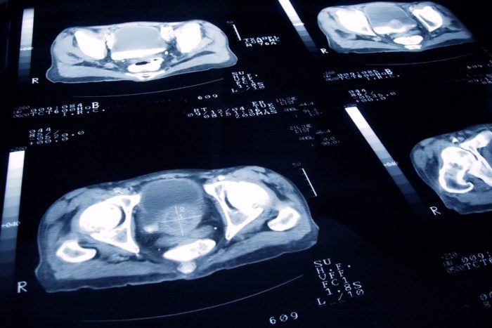 prostate cancer imaging
