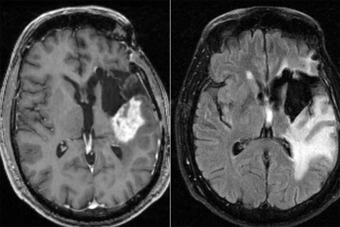 Glioblastoma Brain Scan
