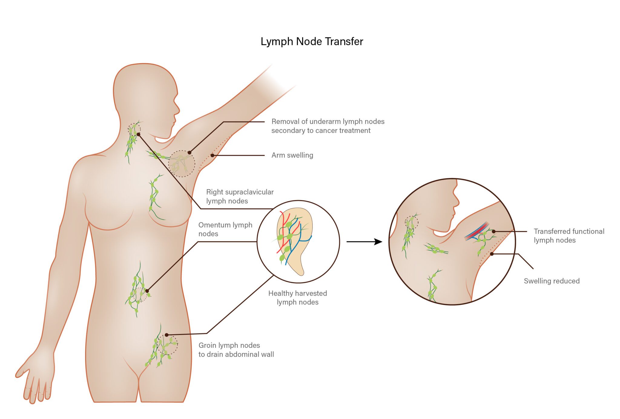 Breast lymph nodes and lymphatic drainage: Clinical role