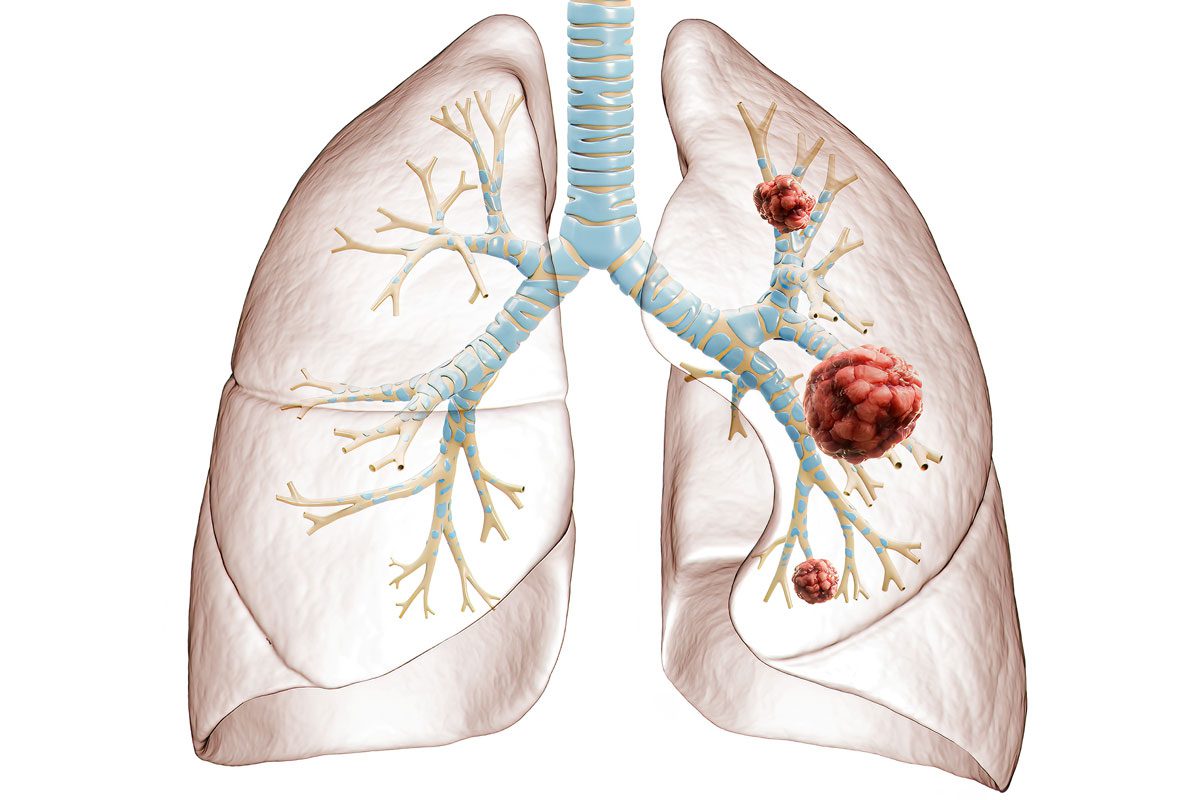 Lungcancergetty