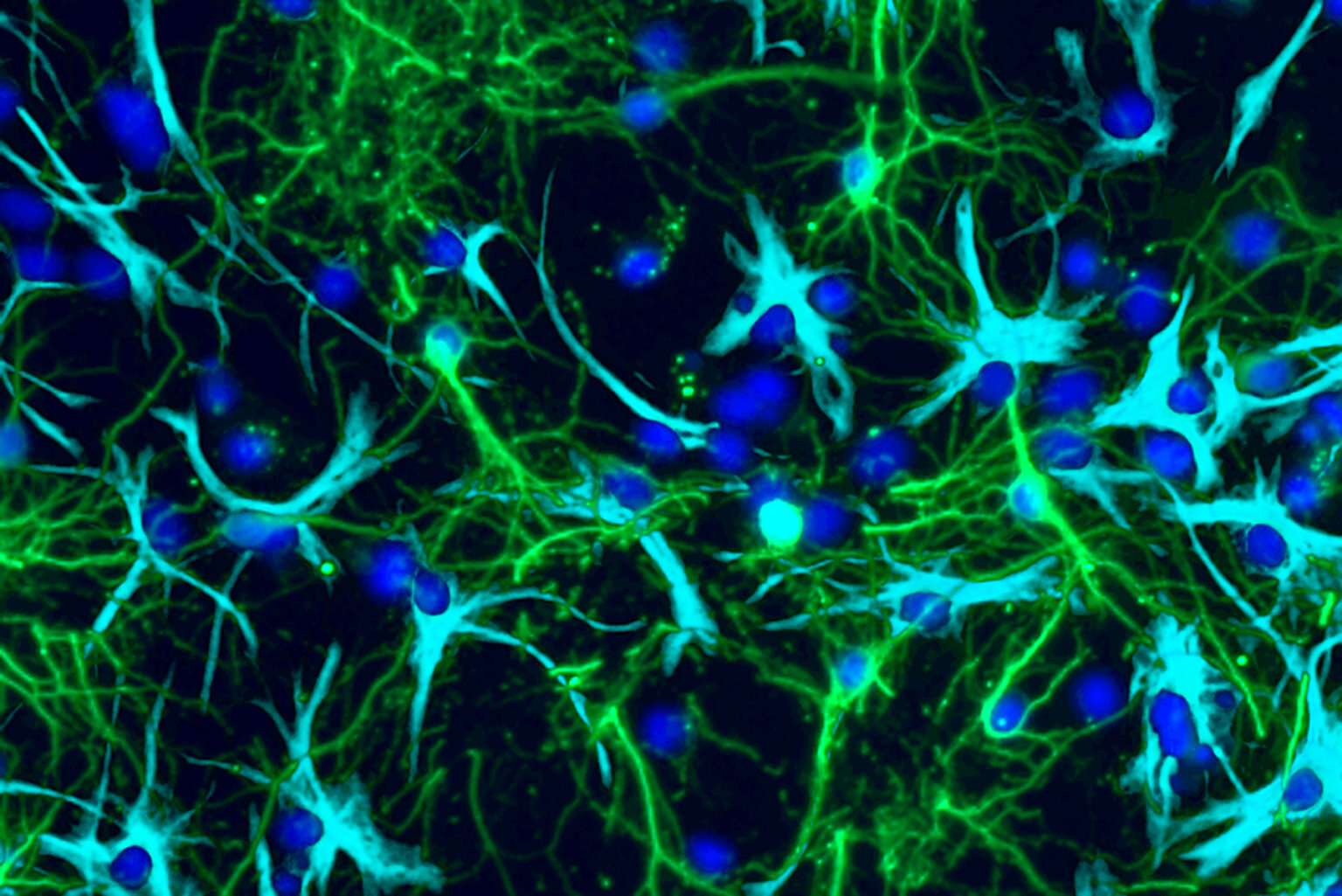 Image Study Sheds Light On How Pediatric Brain Tumors Grow