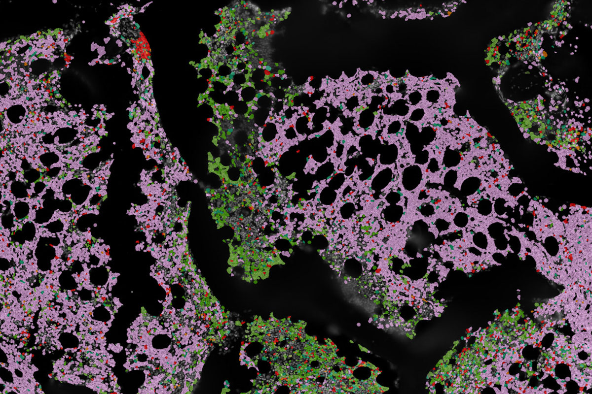 Shown is a sample of bone marrow from a patient with multiple myeloma, indicated by an overabundance of plasma cells (pink) compared with normal bone marrow (green). T cells are in red.