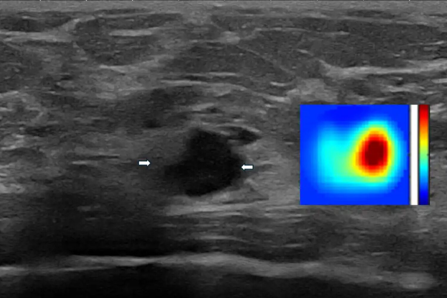 A targeted-ultrasound image shows an irregular mass, which a biopsy later determined to be cancerous.