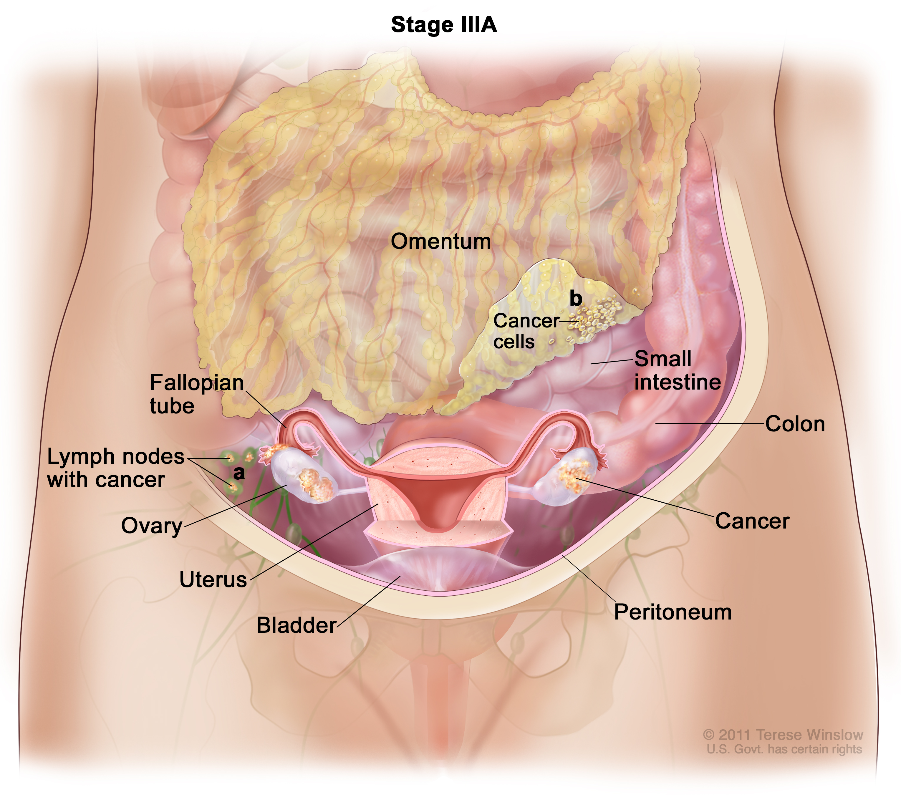 peritoneal cancer after total hysterectomy