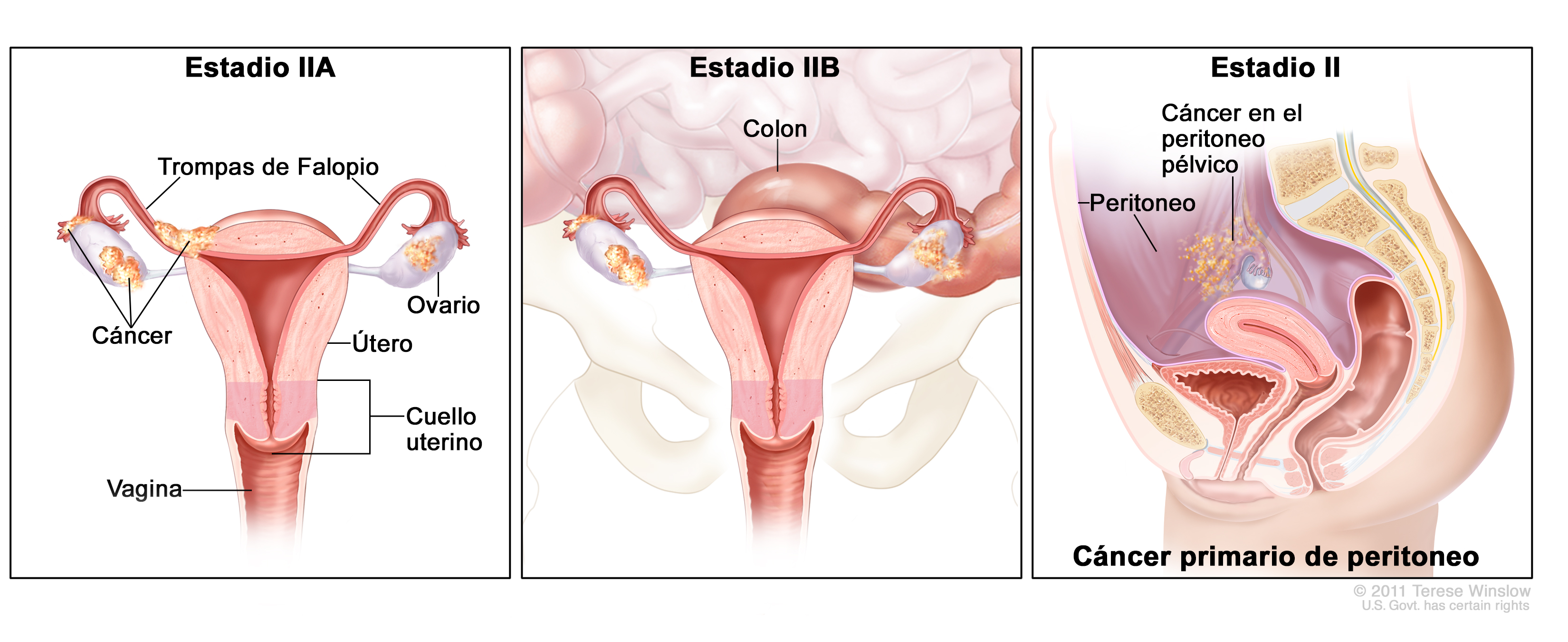 Cancer peritoneal – simptome, cauze, diagnostic, tratament