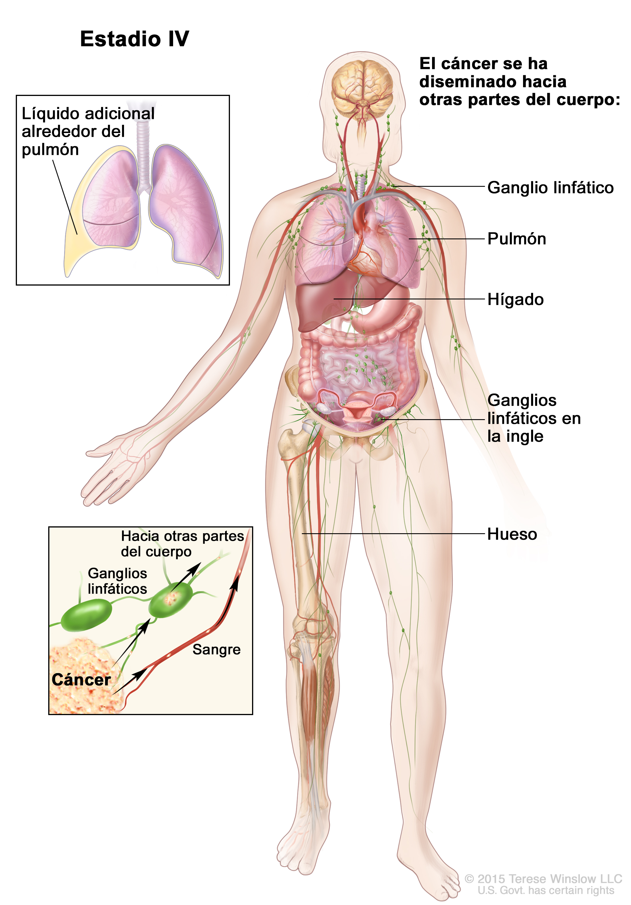 Cancer peritoneal etapa 4, Câți oameni trăiesc cu cancerul de rinichi în stadiul 4