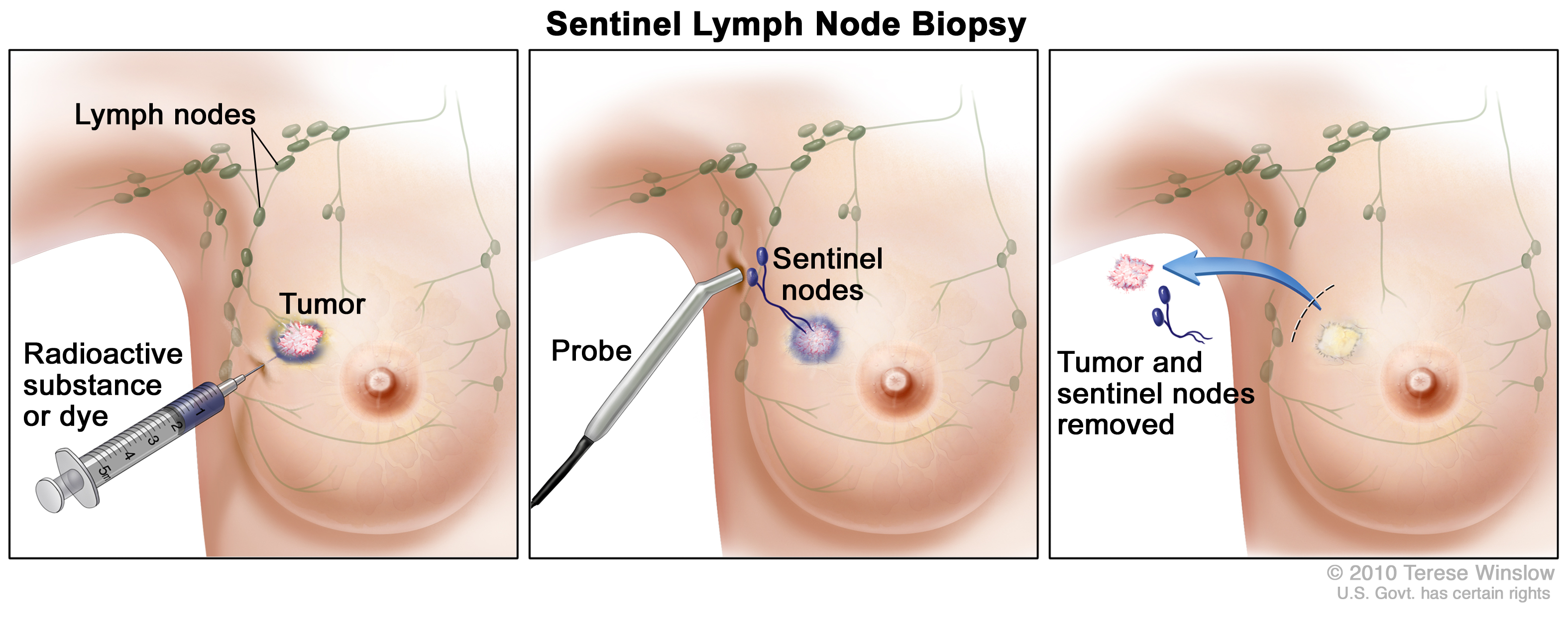 sentinel lymph node biopsy (patient) - siteman cancer center