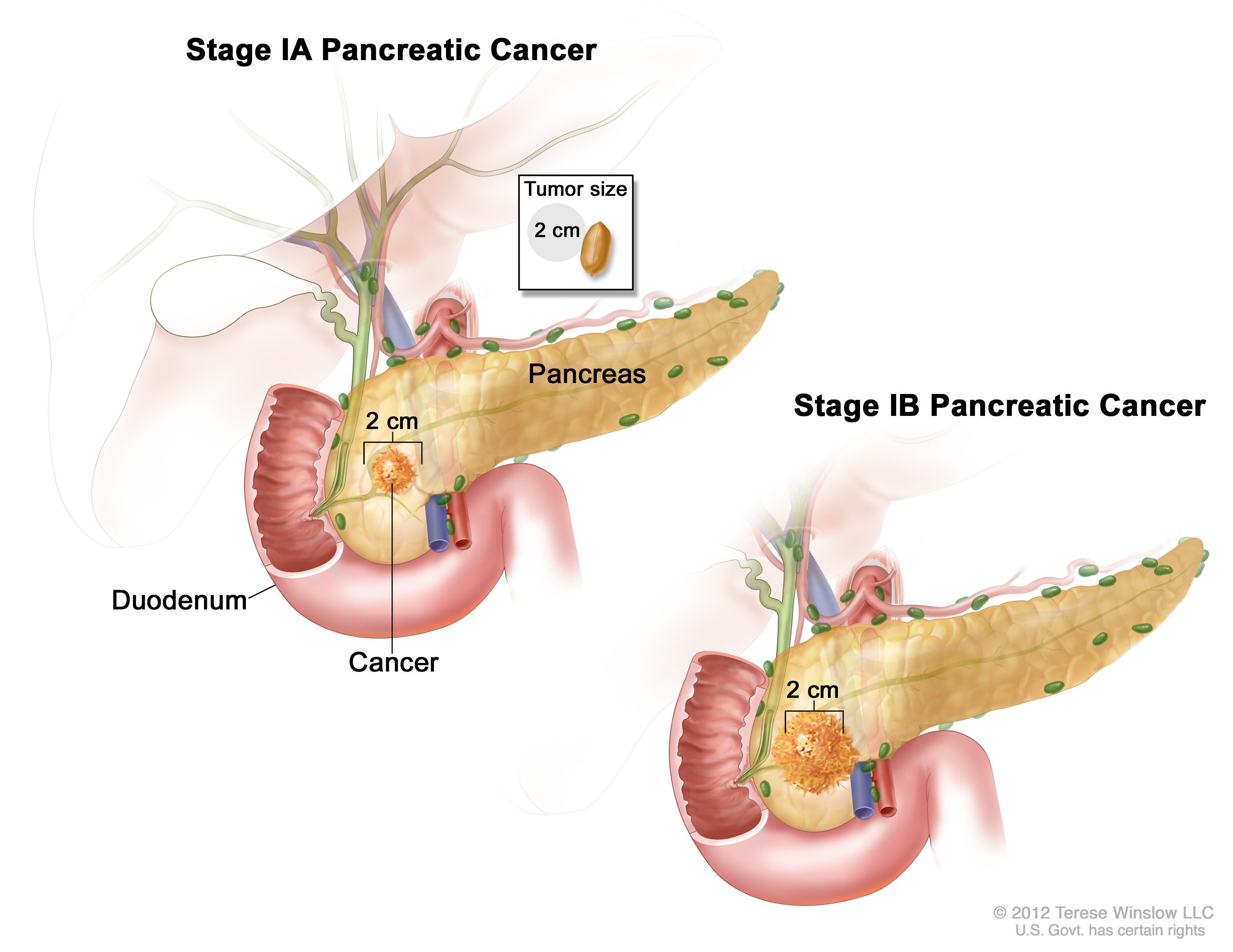 pancreatic cancer stages