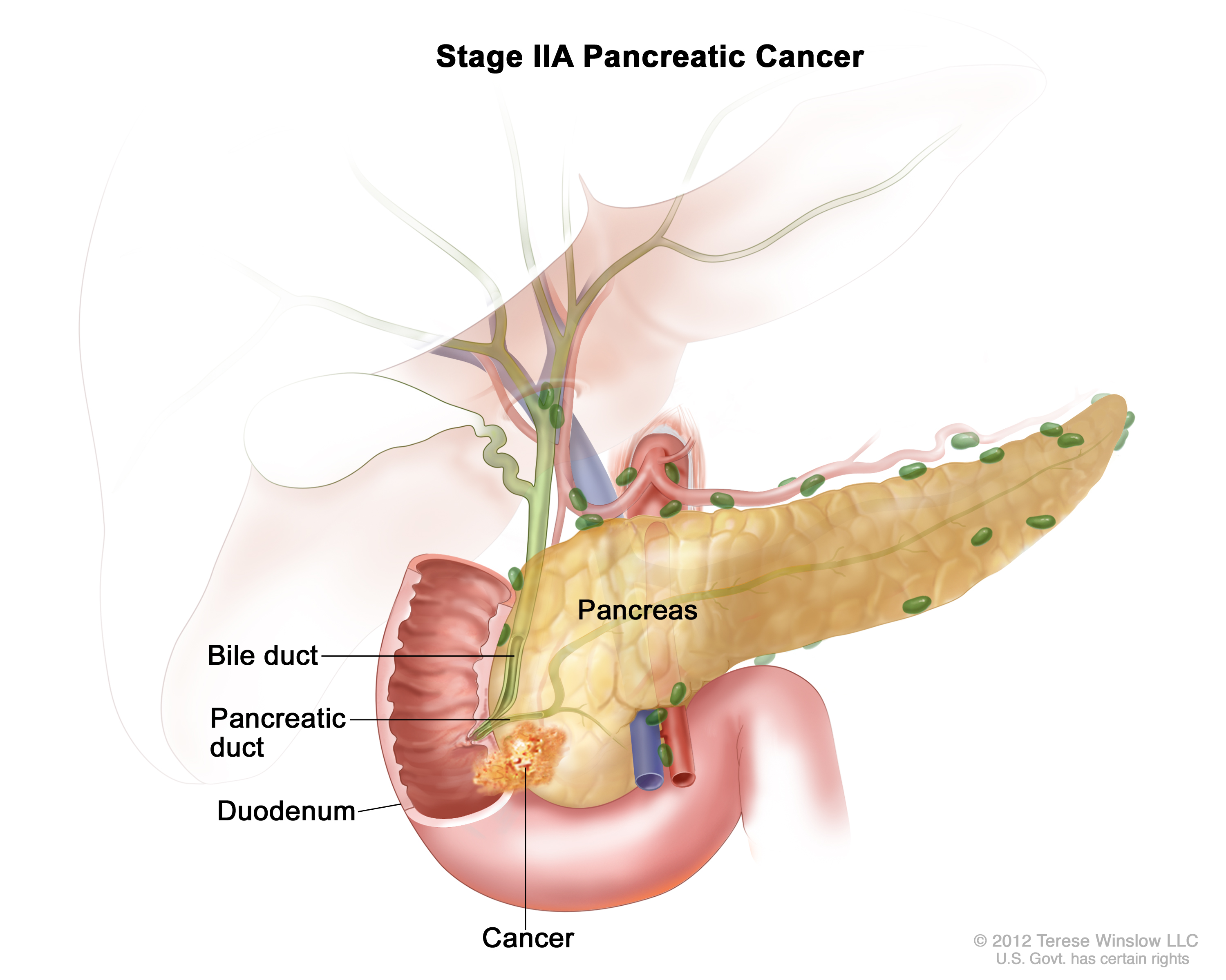 Distal Stages And Grades Bile Duct Cancer Cancer Research Uk