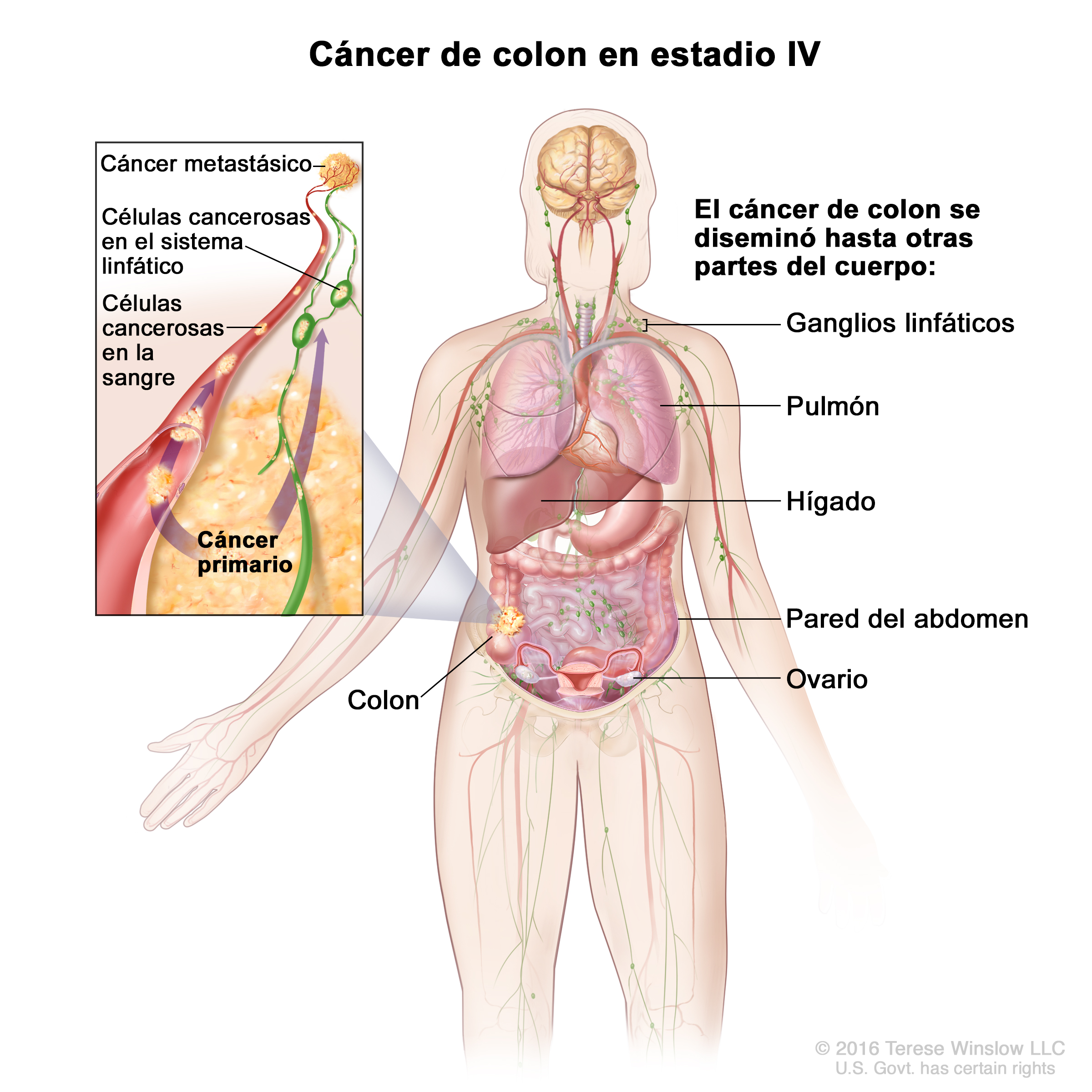 cancer colon higado