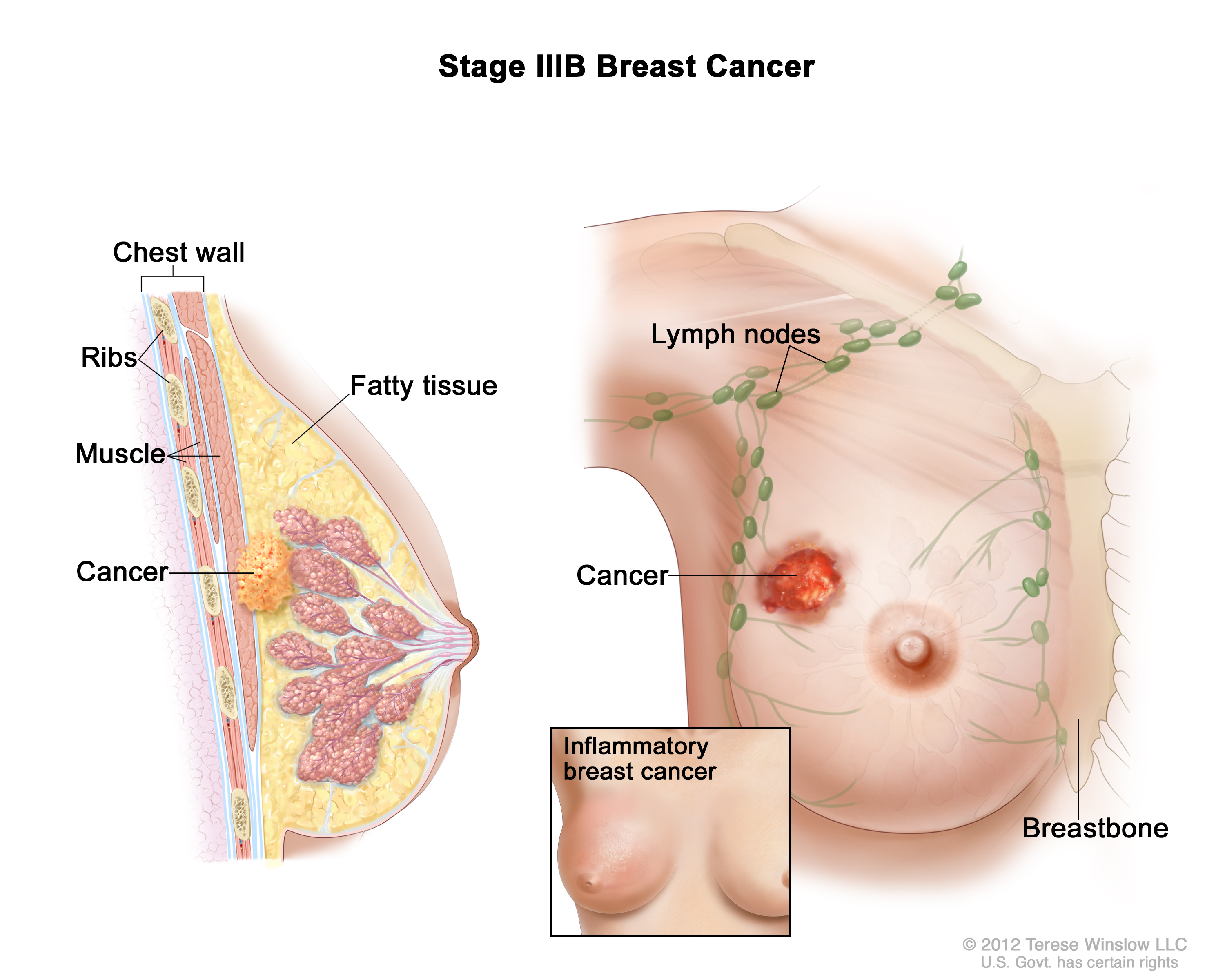 Stage Iii Breast Cancer Patient Siteman Cancer Center