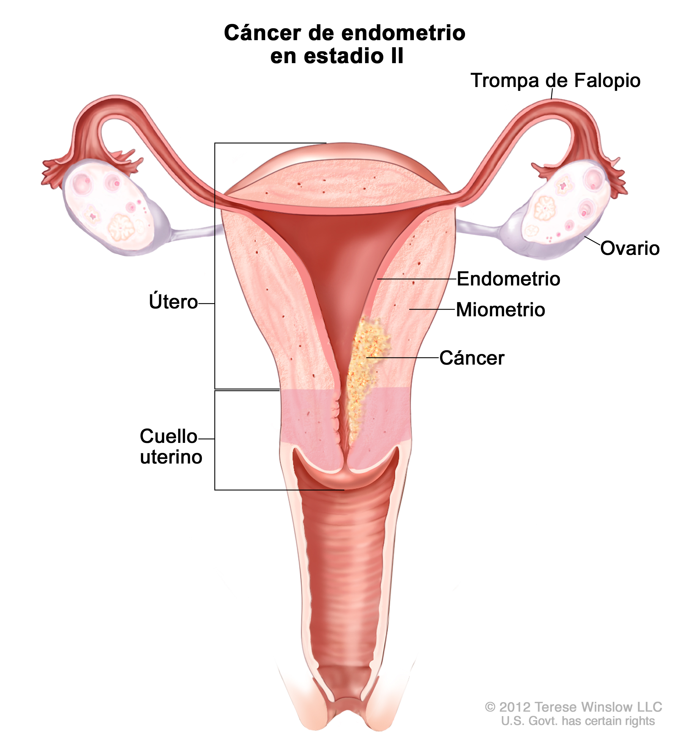Cancer endometrial histeroscopia