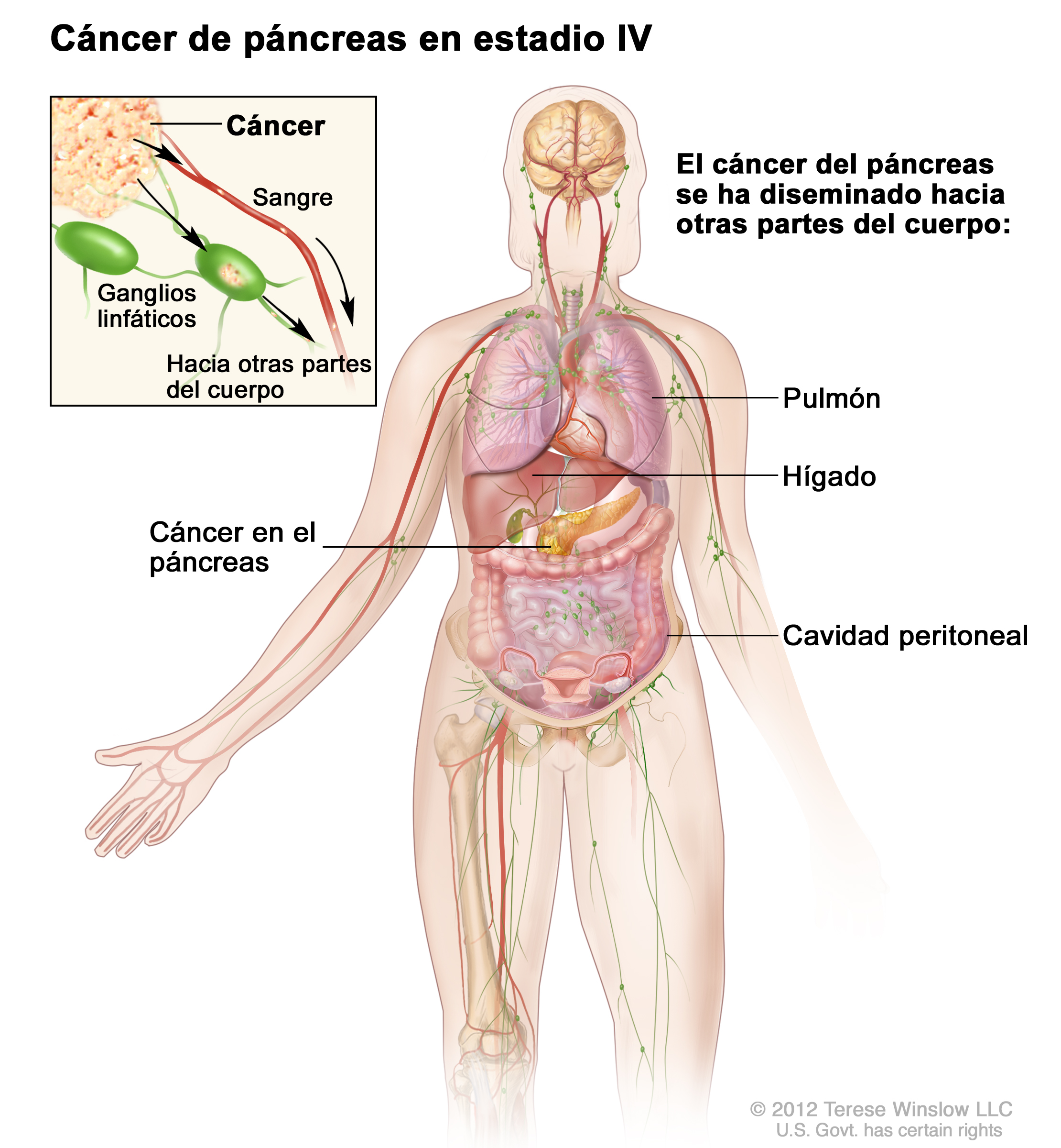 cancer peritoneal estadio 4