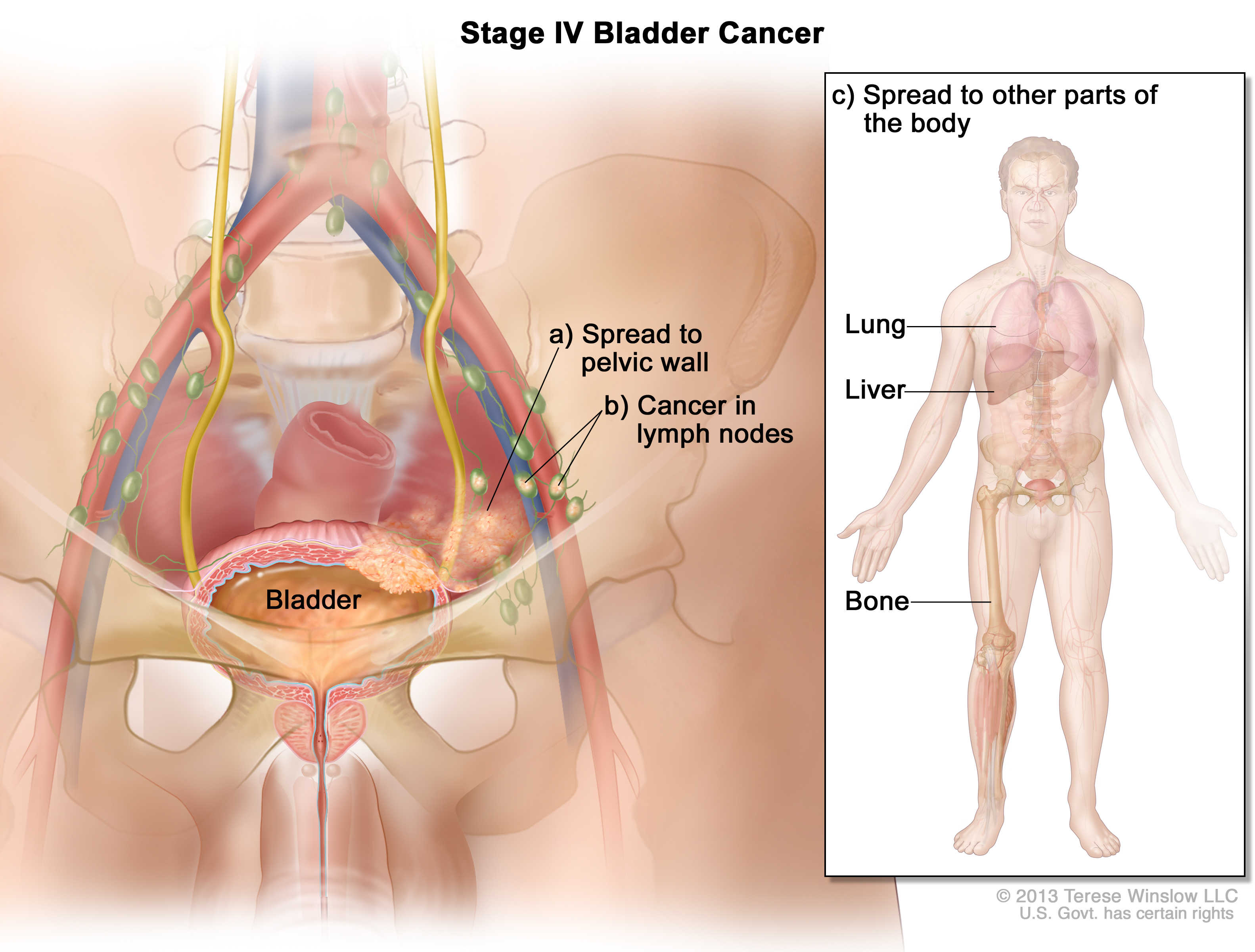 bladder neck cancer treatment)