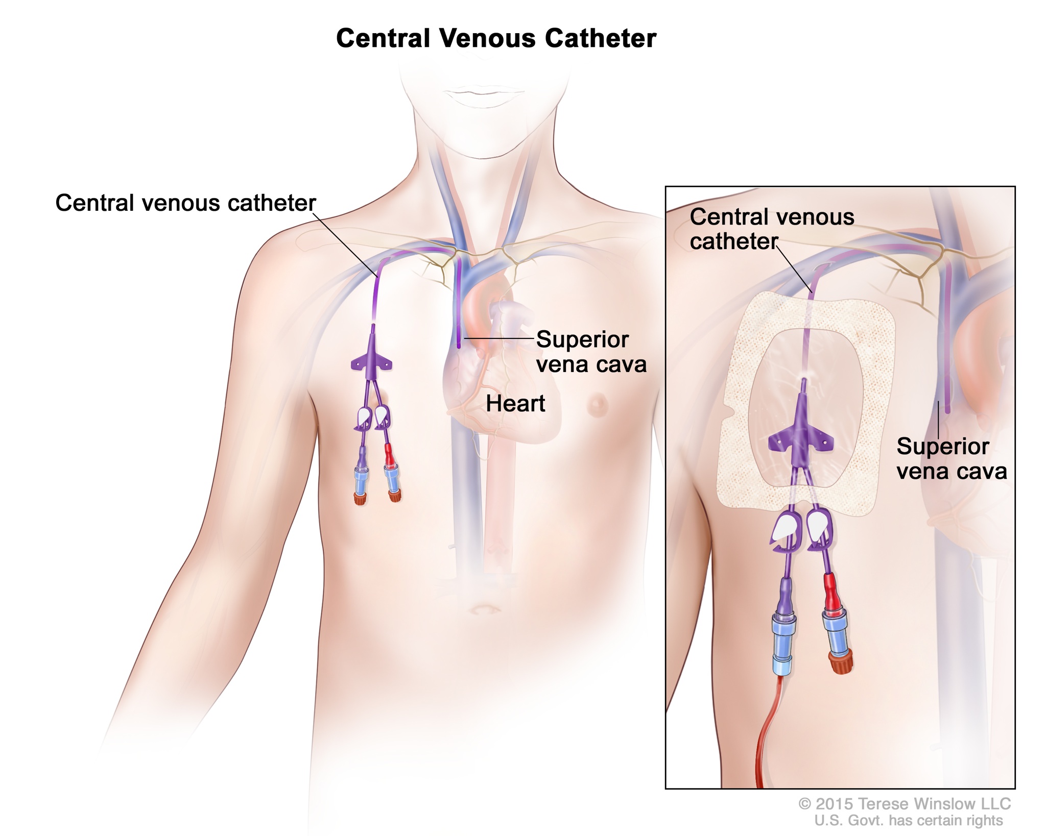 central-venous-access-catheter-patient-siteman-cancer-center