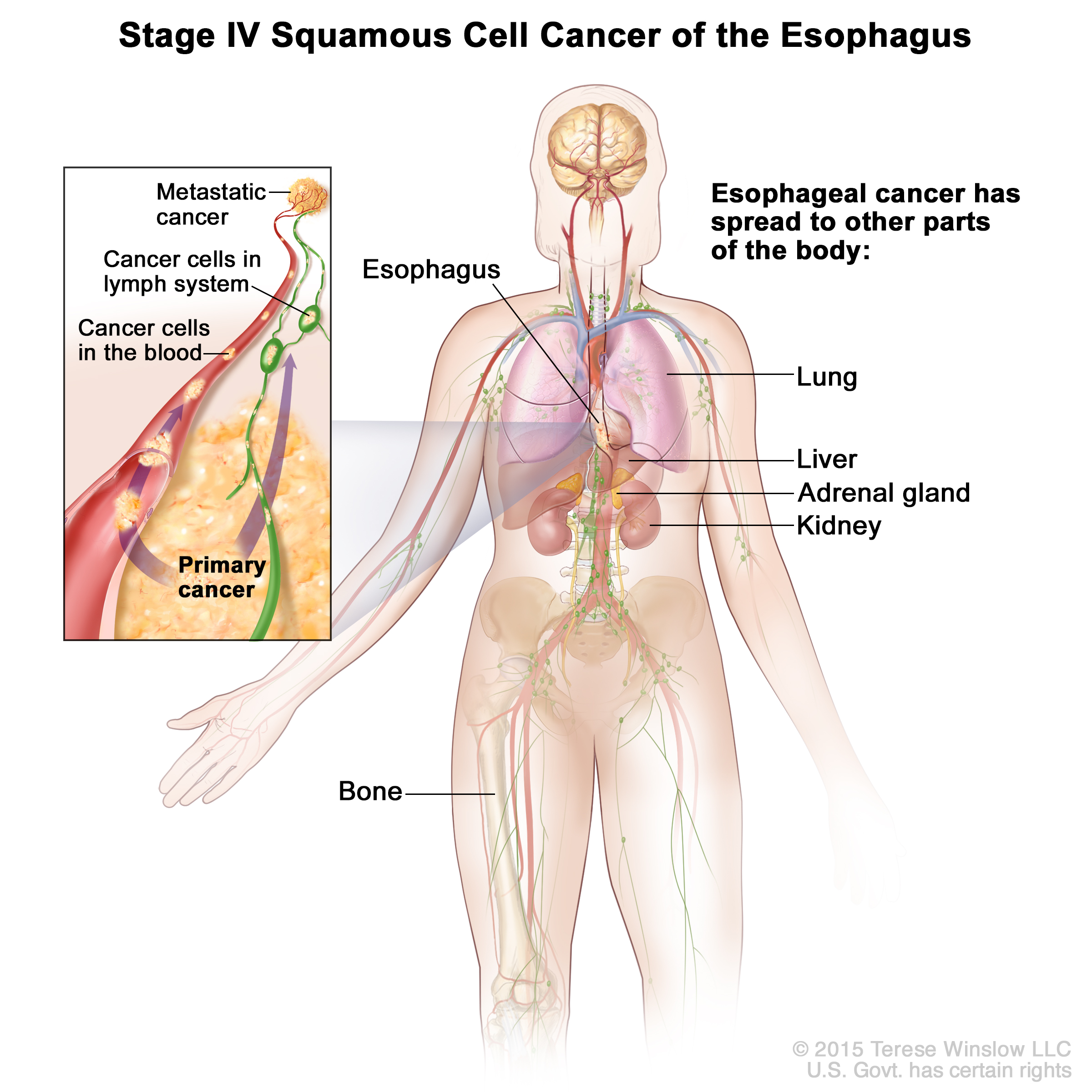 metastatic cancer esophageal papilom inversat