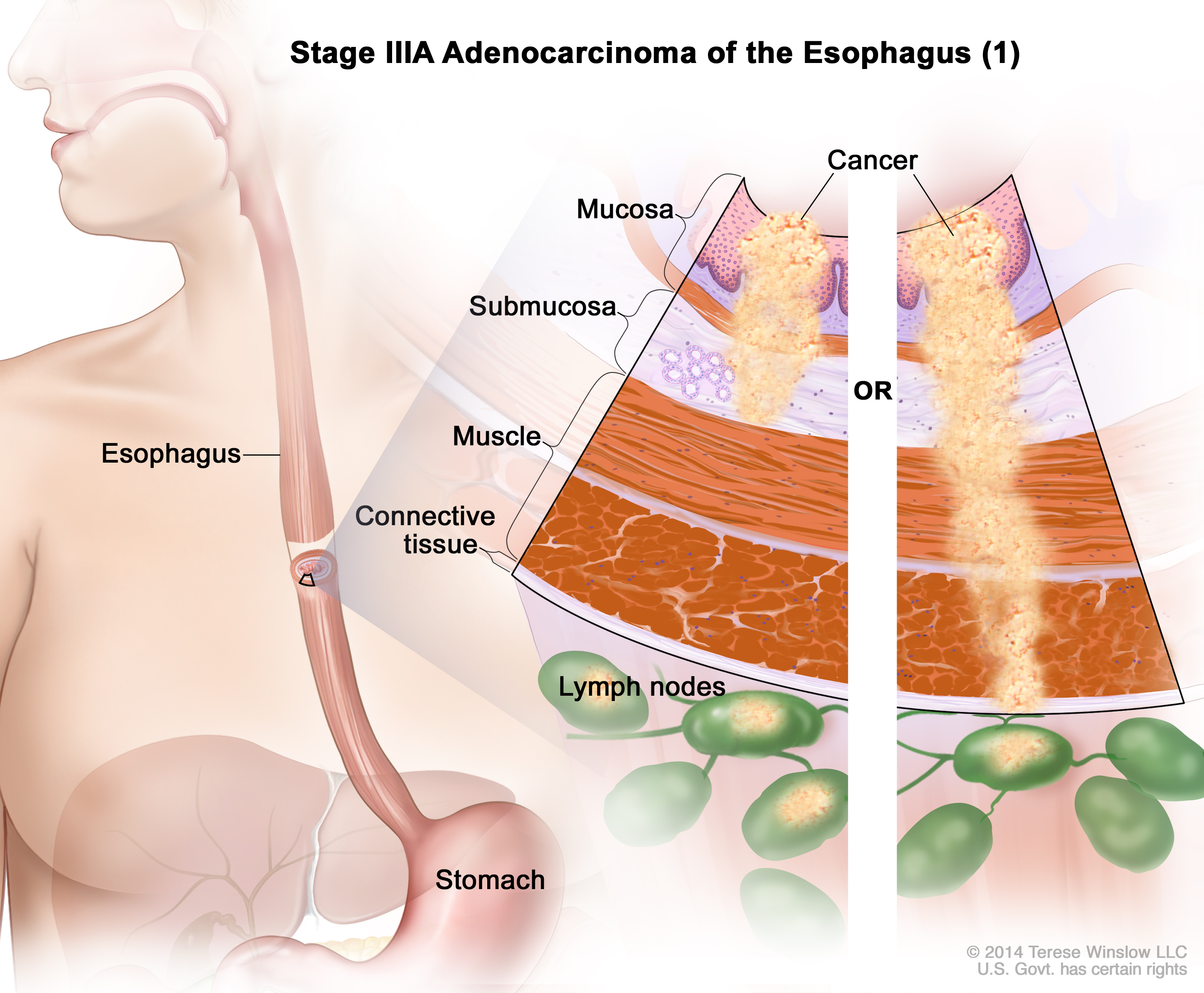 Esophageal Cancer Treatment  Adult   Pdq U00ae   Patients