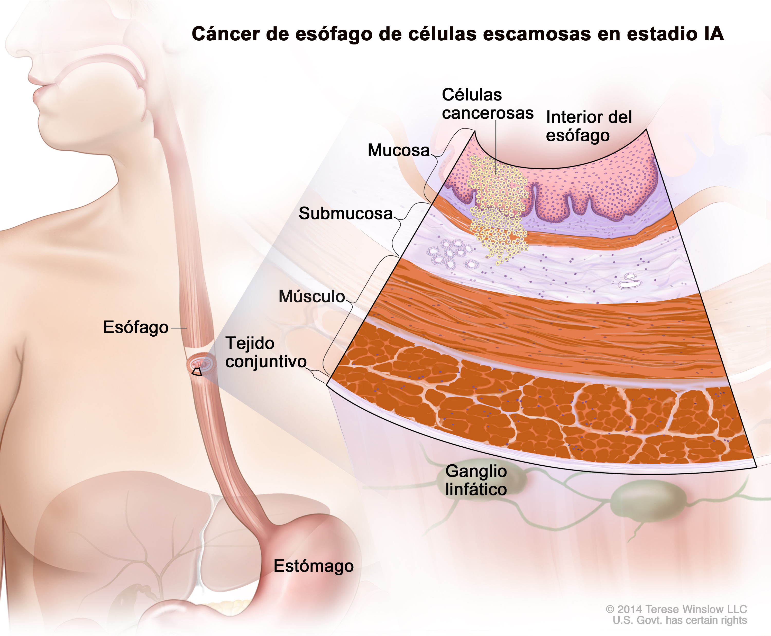 Stage I Esophageal Squamous Cell Carcinoma  Patient